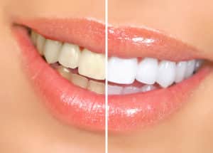 kobak teeth whitening (2)