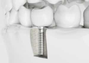 how-to-reconstruct-a-smile-with-dental-implants
