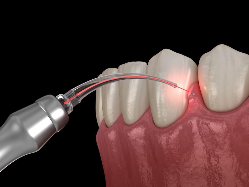 Dental Diode Lasers, Soft-Tissue Lasers