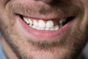 Close Up Photo Of Young Man With Missing Tooth