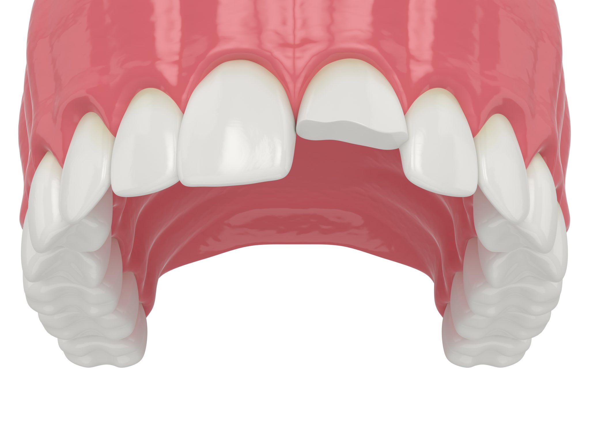 Syosset Dentist Explains How Bonding Improves A Tooth’s Health And