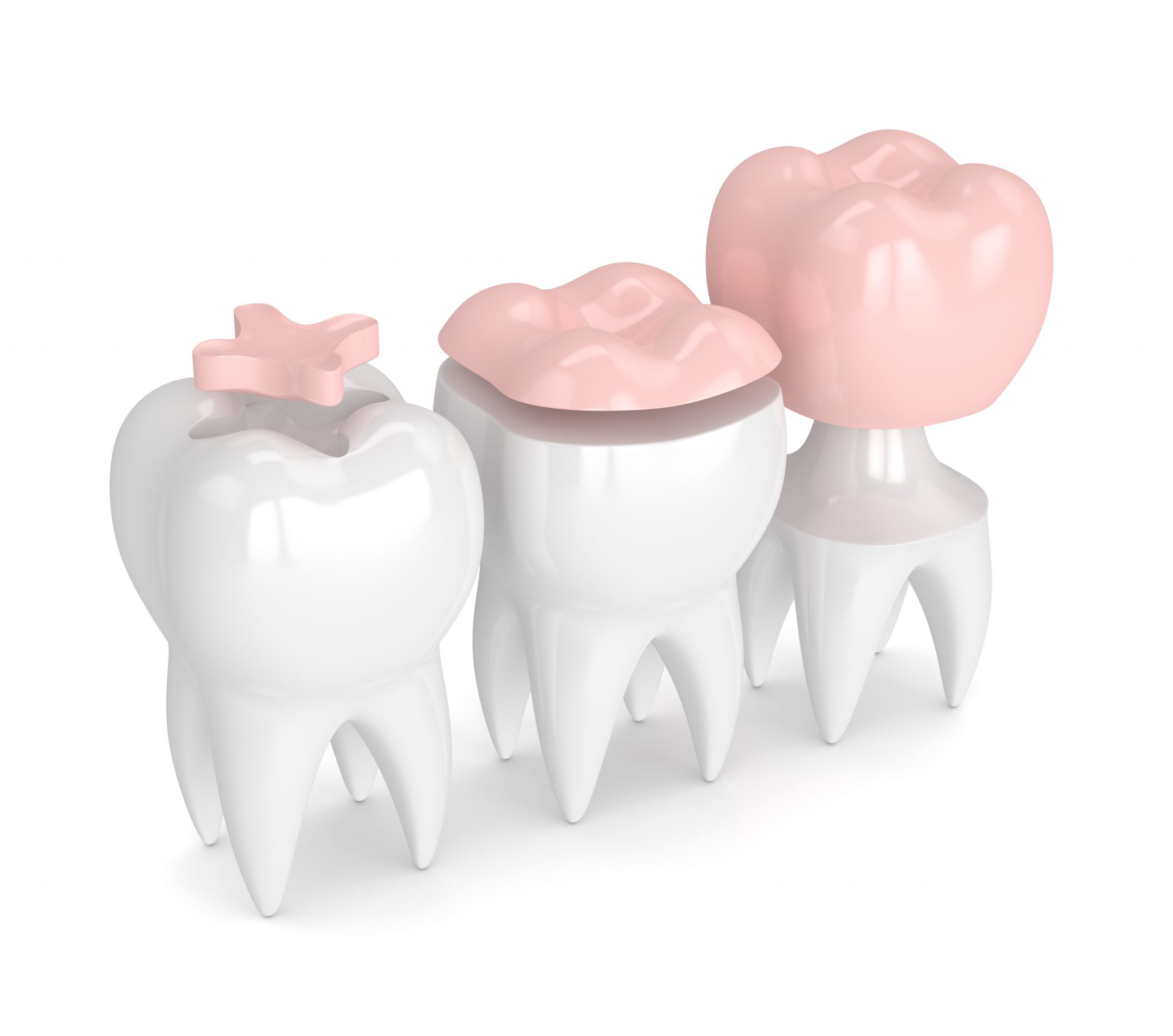 Syosset Dentist Creates Full And Partial Crowns That Look Natural