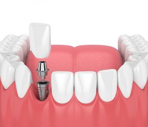 syosset dental implant placement