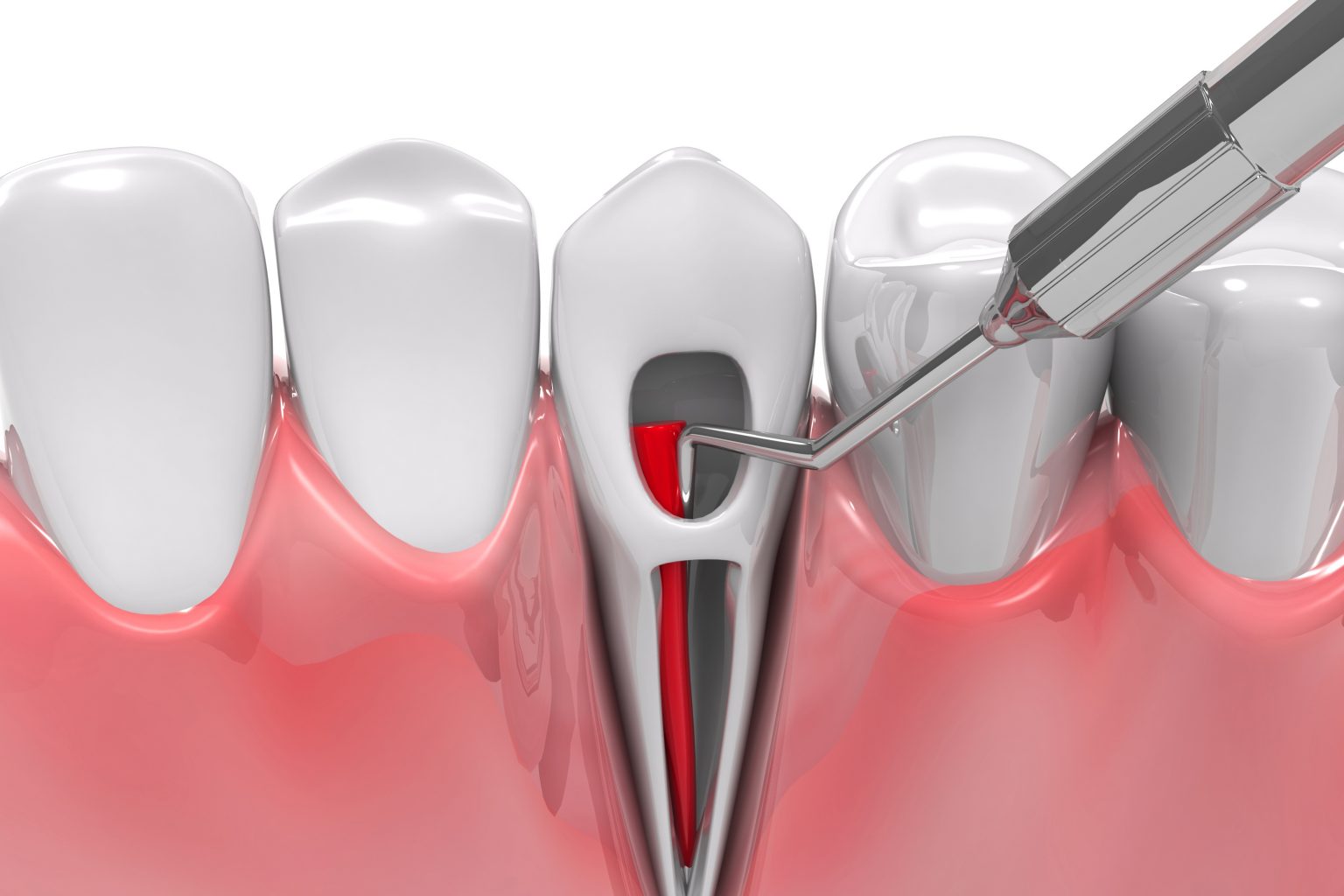 Syosset Dentist Talks About The Benefits Of A Root Canal Syosset, NY
