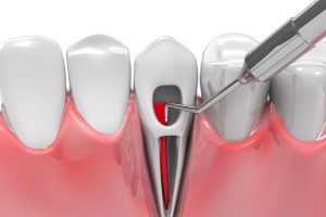 syosset root canal