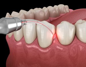 syosset dental lasers