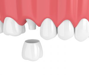 syosset dental crowns