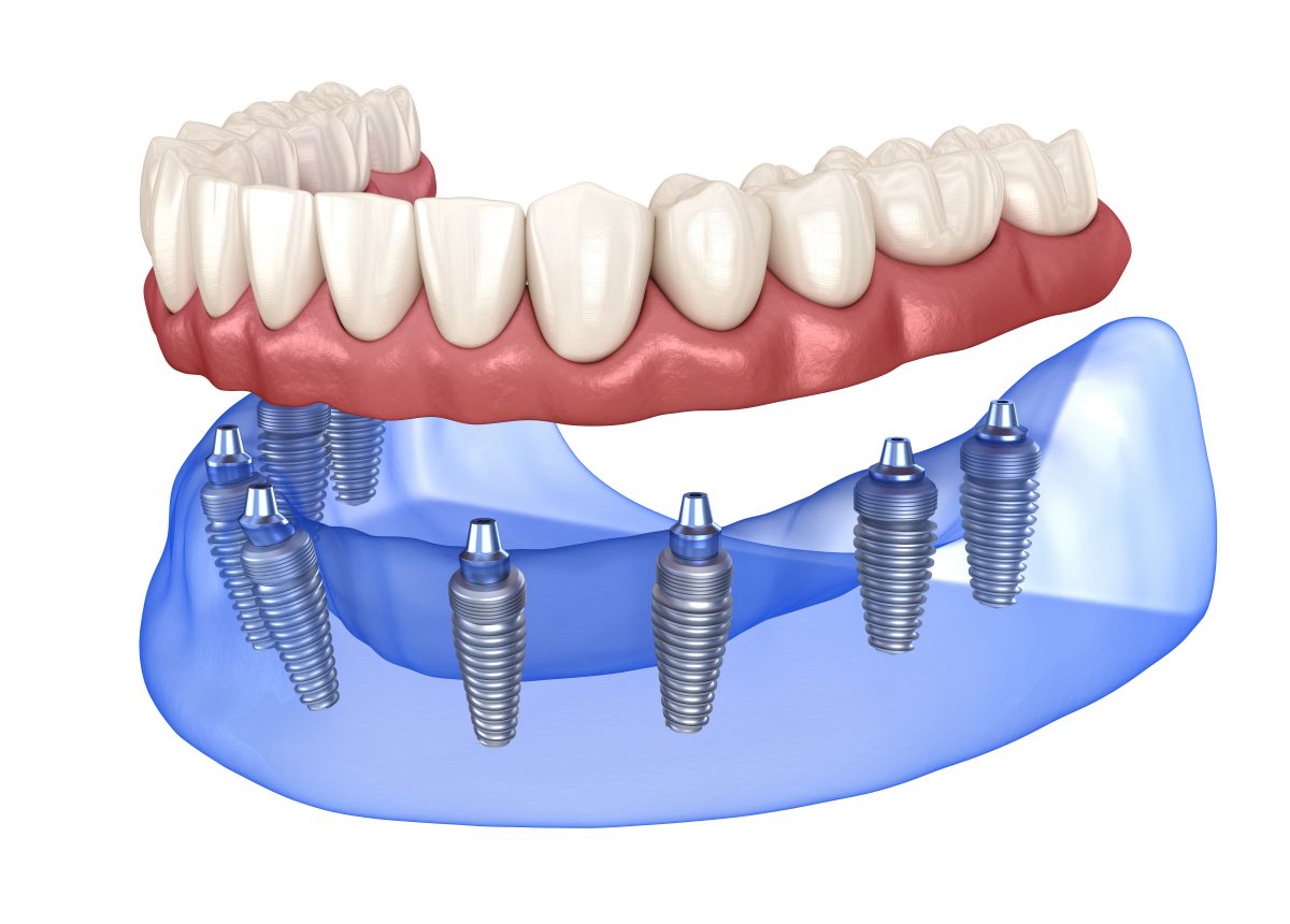 How Does An Implant Replace Missing Teeth? Syosset, NY