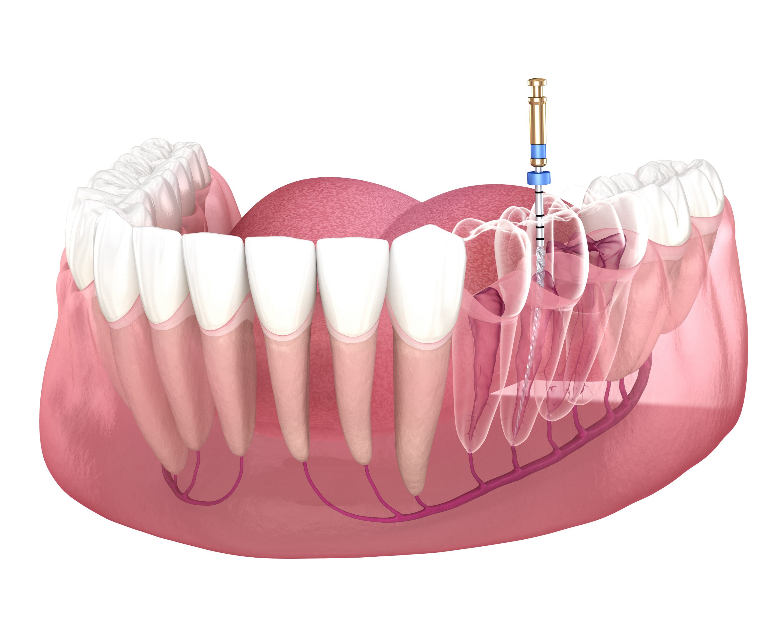 syosset root canal