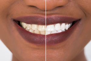 syosset teeth whitening