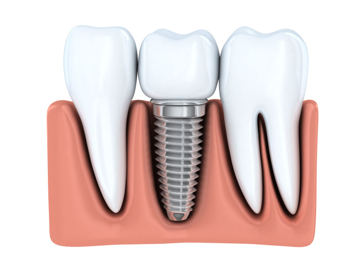 Dental Implants Replace Your Missing Teeth Syosset, NY