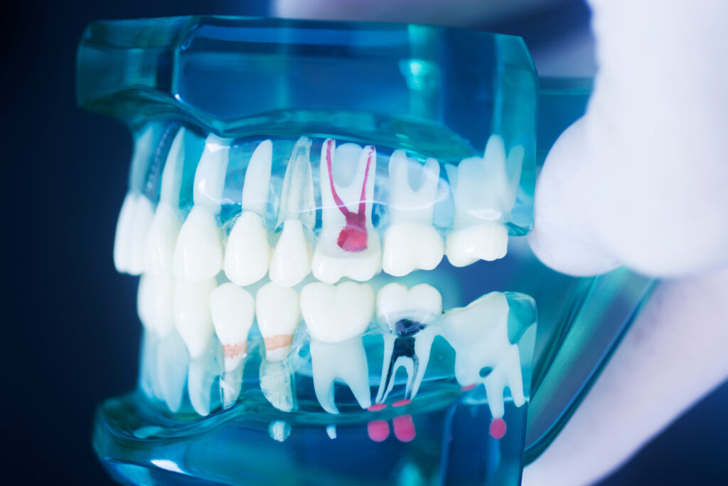 When a Filling Isn’t Enough Root Canal Therapy Syosset, NY