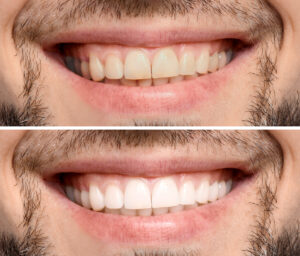 syosset teeth whitening