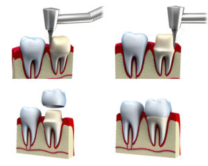 syosset dental crowns