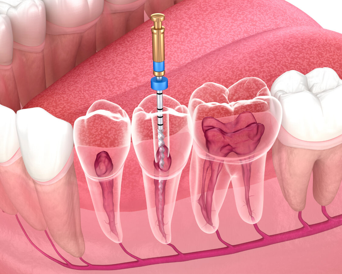 Root Canal Therapy Stops Tooth Pain Syosset, NY