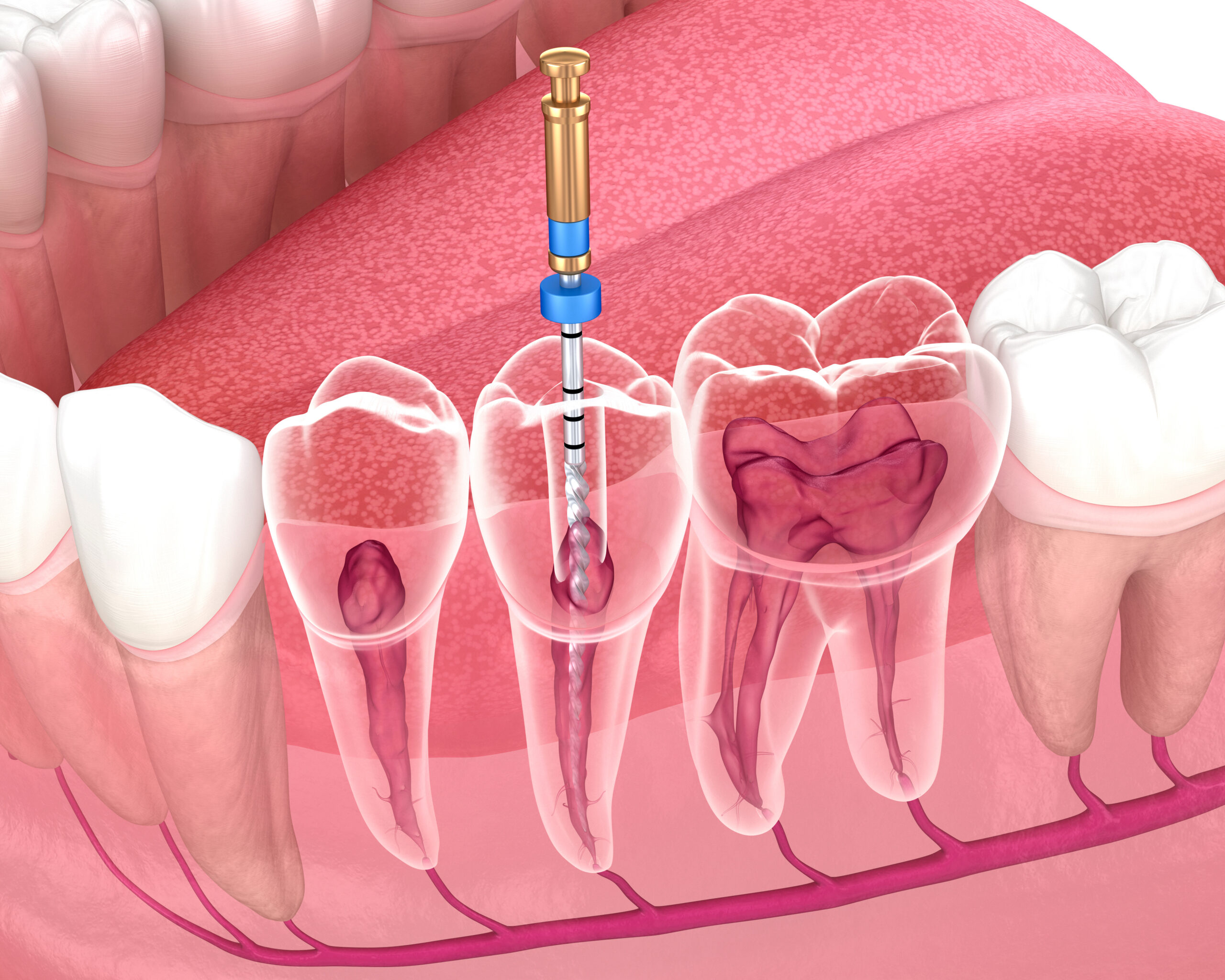 syosset root canal treatment