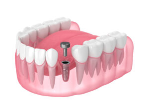 syosset dental implants