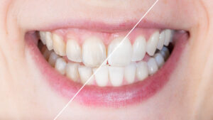 syosset teeth whitening