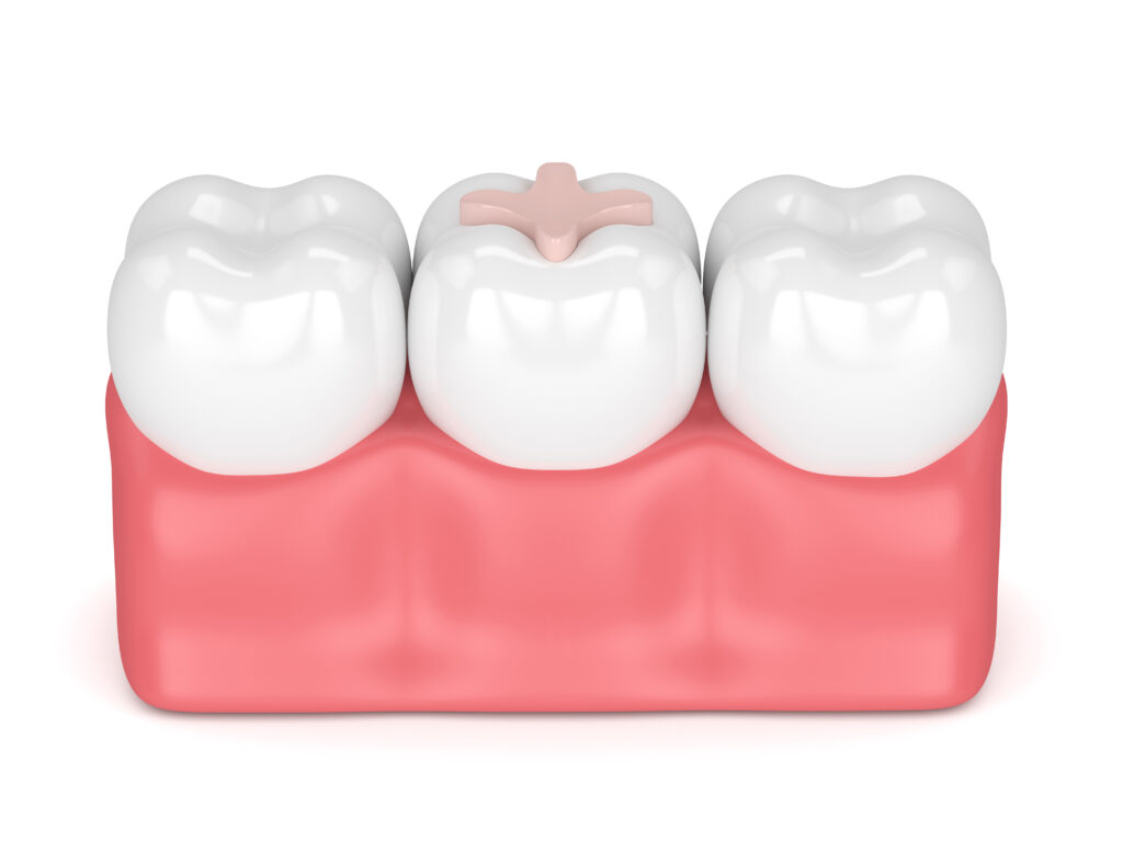 Placing Dental Fillings That Appear Natural Syosset, NY