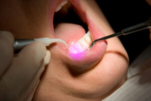 syosset dental laser