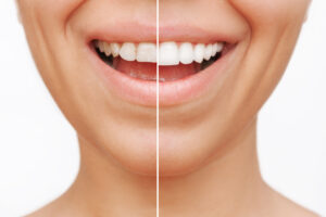 syosset veneers