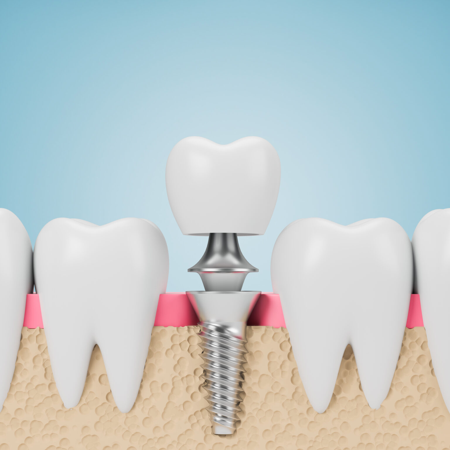 Dental Implants Look And Act Like Natural Teeth Syosset, NY