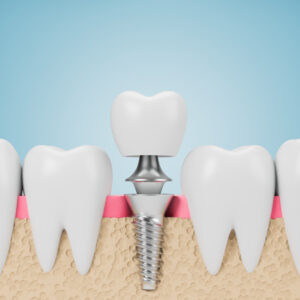 syosset dental implants