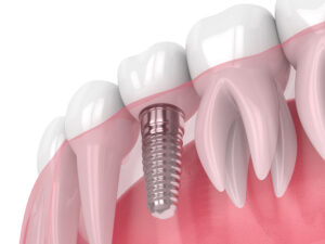 syosset dental implants