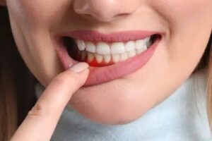 Gum-Disease-Treatment-Syosset-New-York