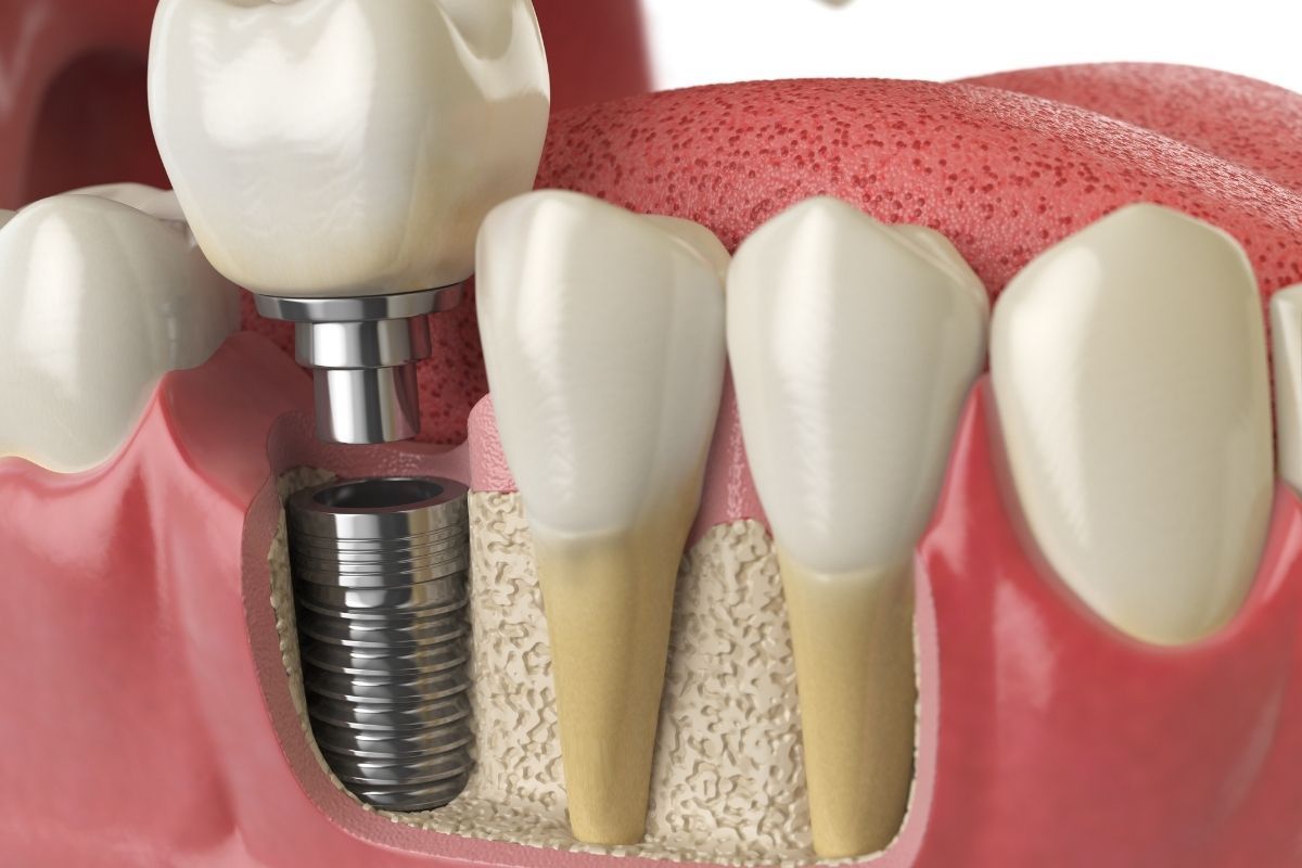 dental implants syosset
