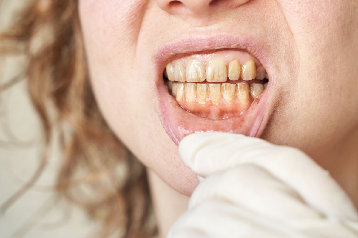 Patient showing tetracycline-stained teeth during dental examination