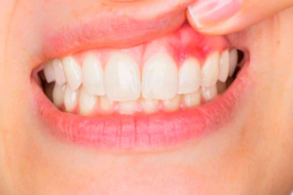 Swollen gums showing early signs of gum disease