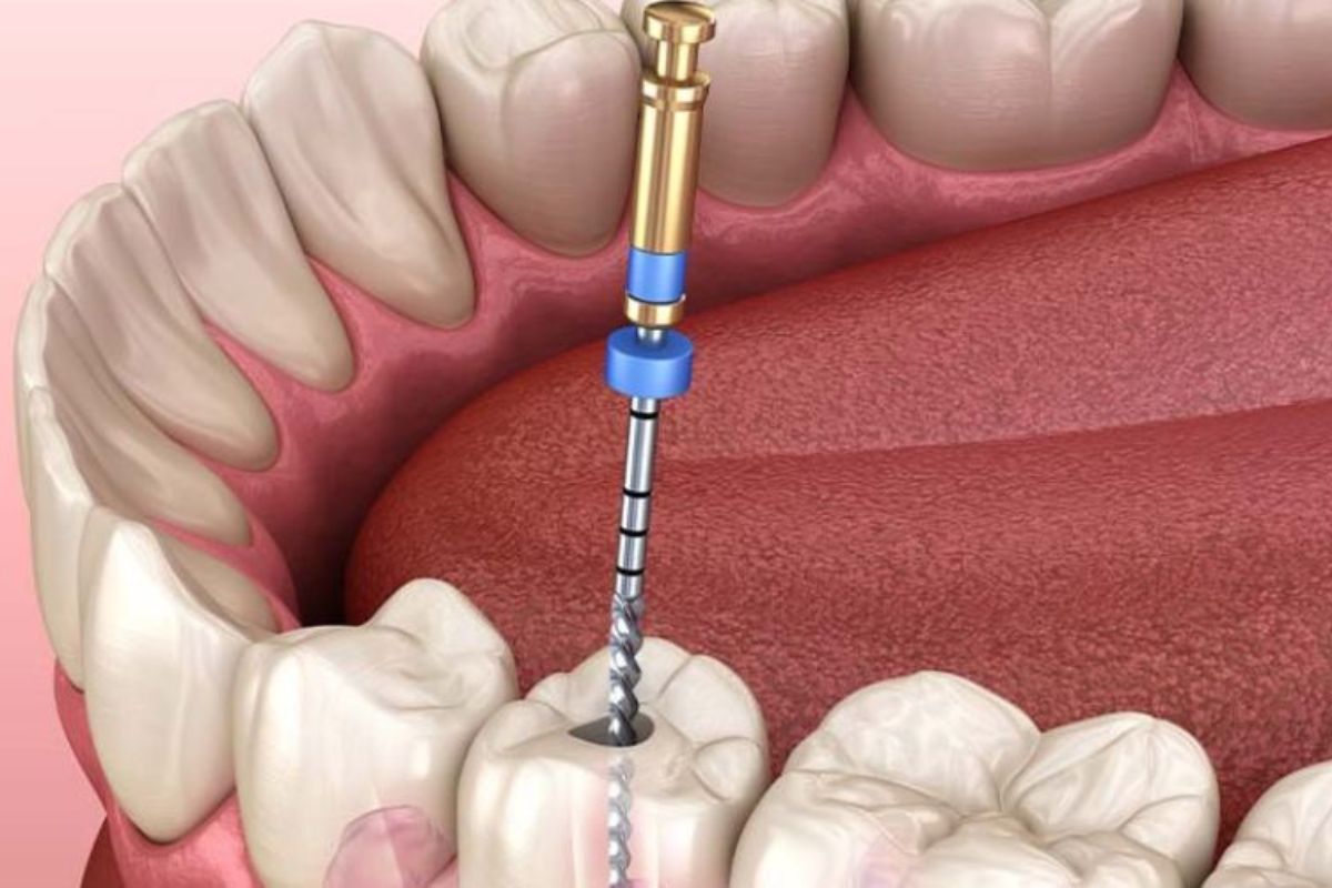 Modern root canal procedure for repairing a cracked tooth