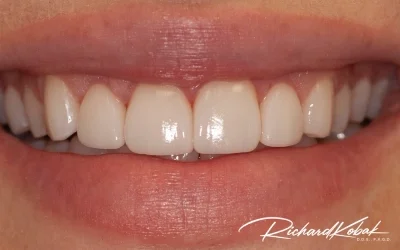 After photo of the patient smiling, showing reduced gum visibility and longer, symmetrical upper teeth.