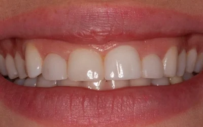 Before photo of a patient smiling, showing a gummy smile with short-appearing upper teeth.