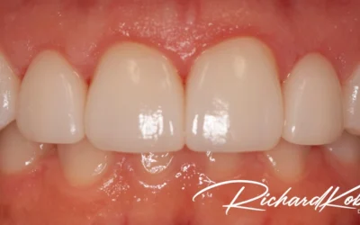Close-up intraoral view after treatment, showing reshaped gum lines and fully exposed upper teeth.