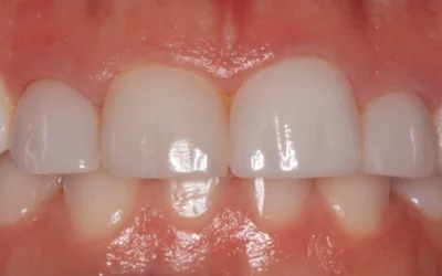 Close-up intraoral view before treatment, showing low gum margins over the upper front teeth.